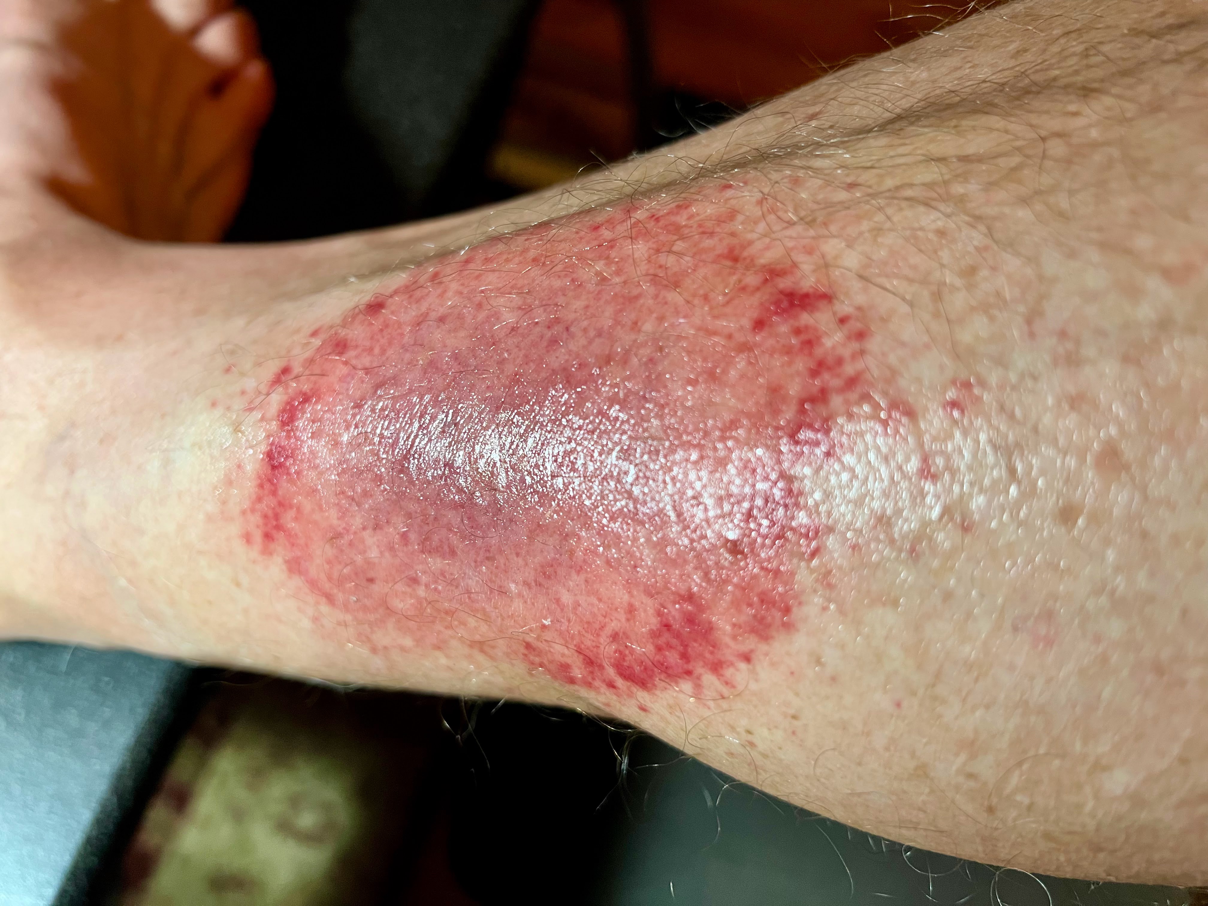 wednesday night red rash with ointment wednesday night red rash with ointment