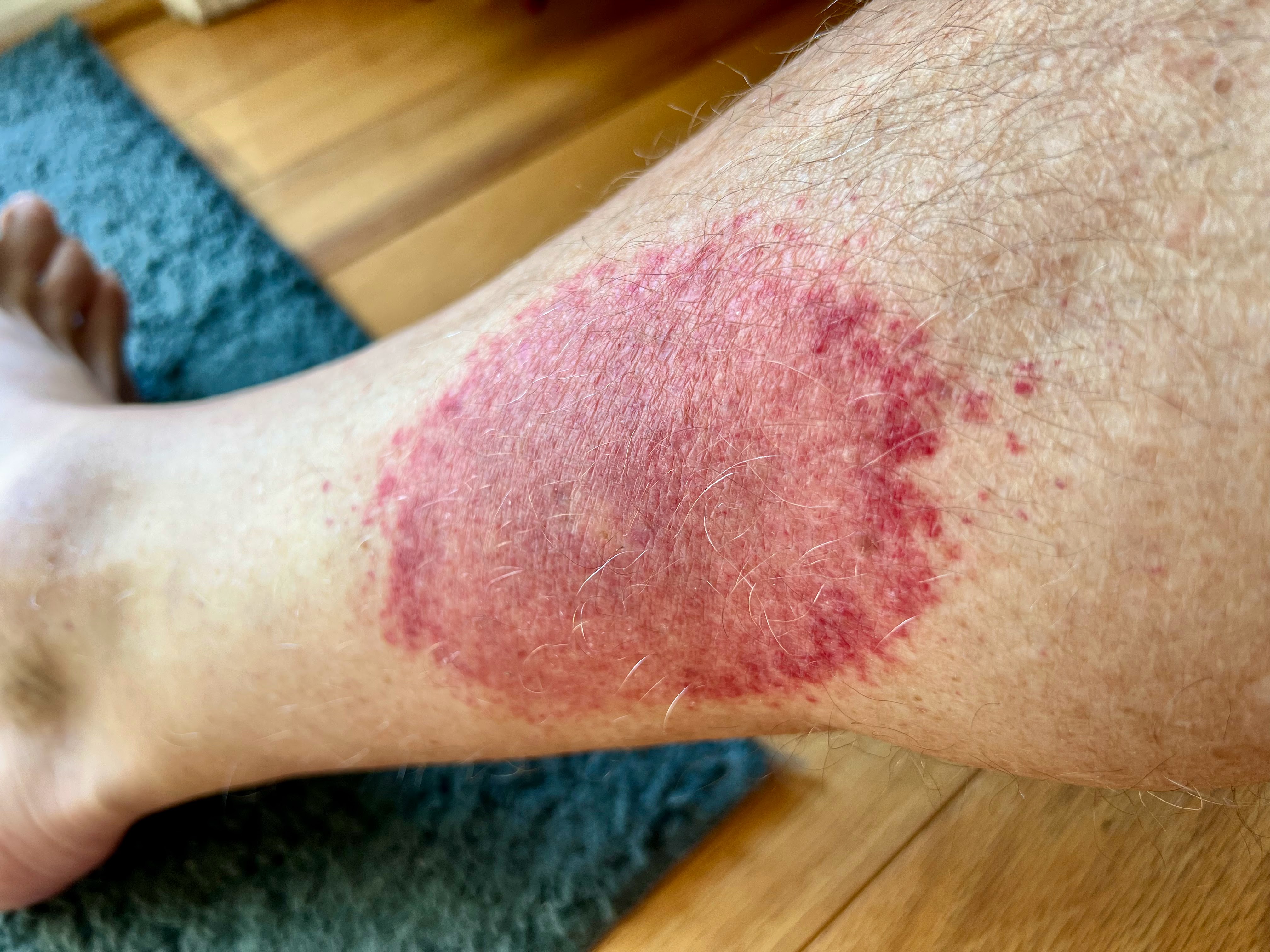 wednesday morning red rash wednesday morning red rash