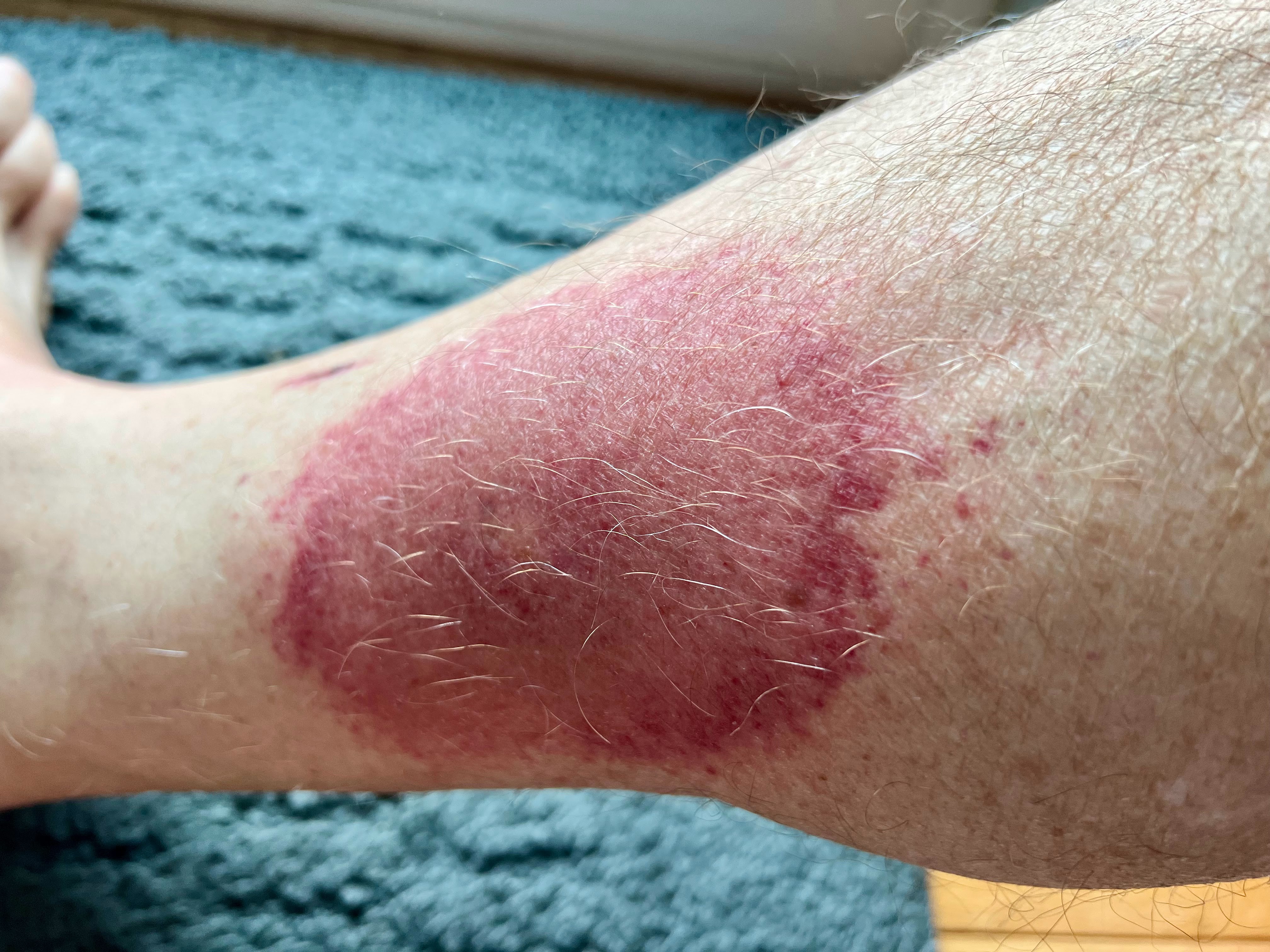 thursday morning red rash thursday morning red rash