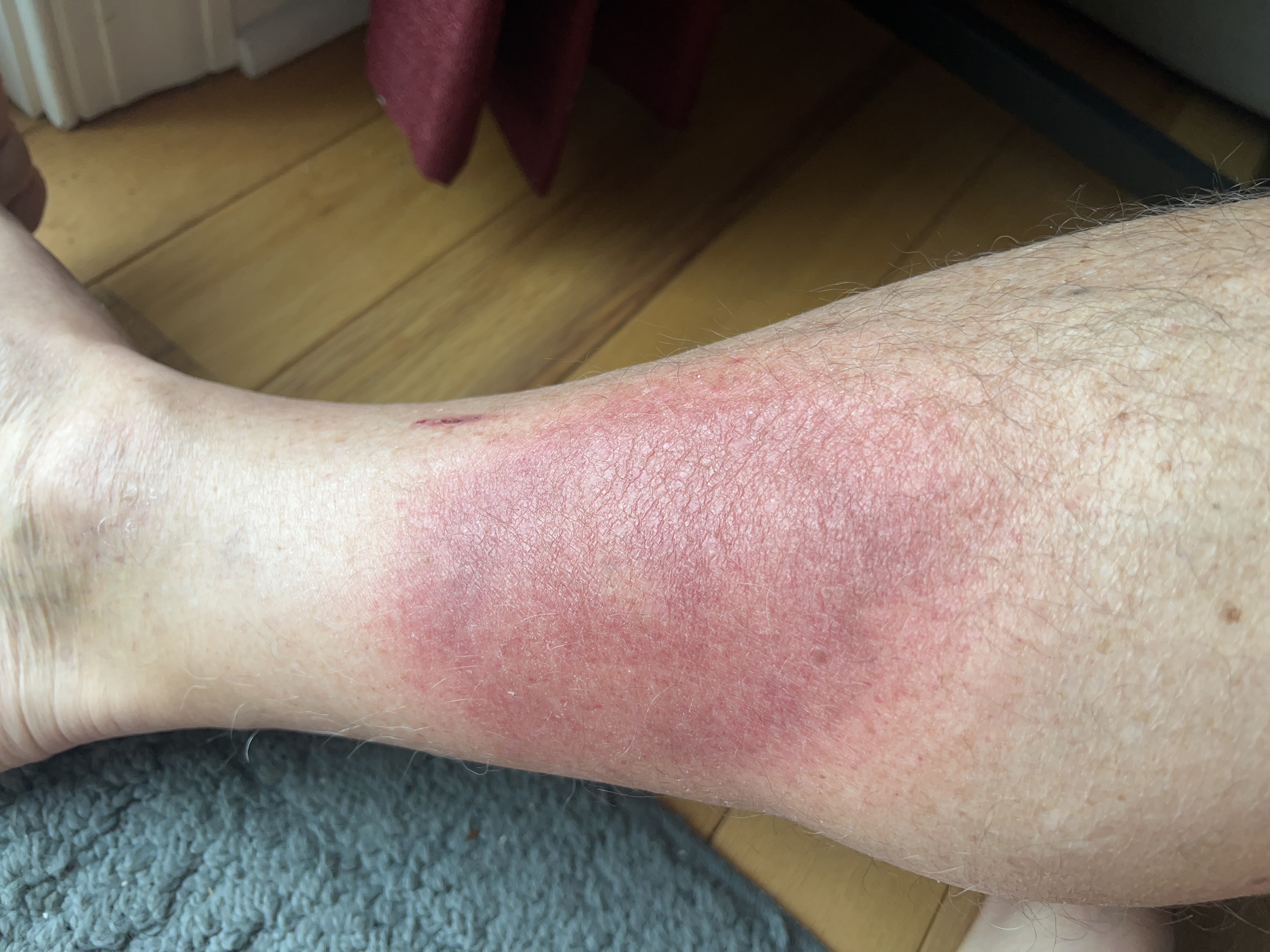 saturday morning red rash 24 hours after beginning doxy saturday morning red rash 24 hours after beginning doxy