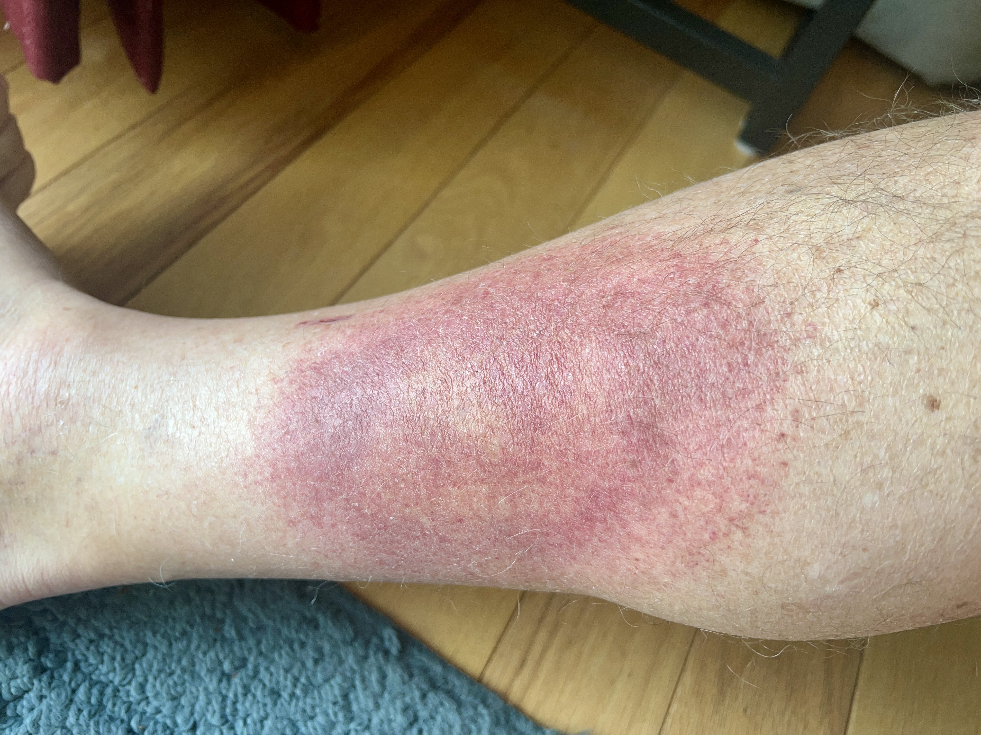 sunday morning red rash | 48 hours on doxy sunday morning red rash | 48 hours on doxy