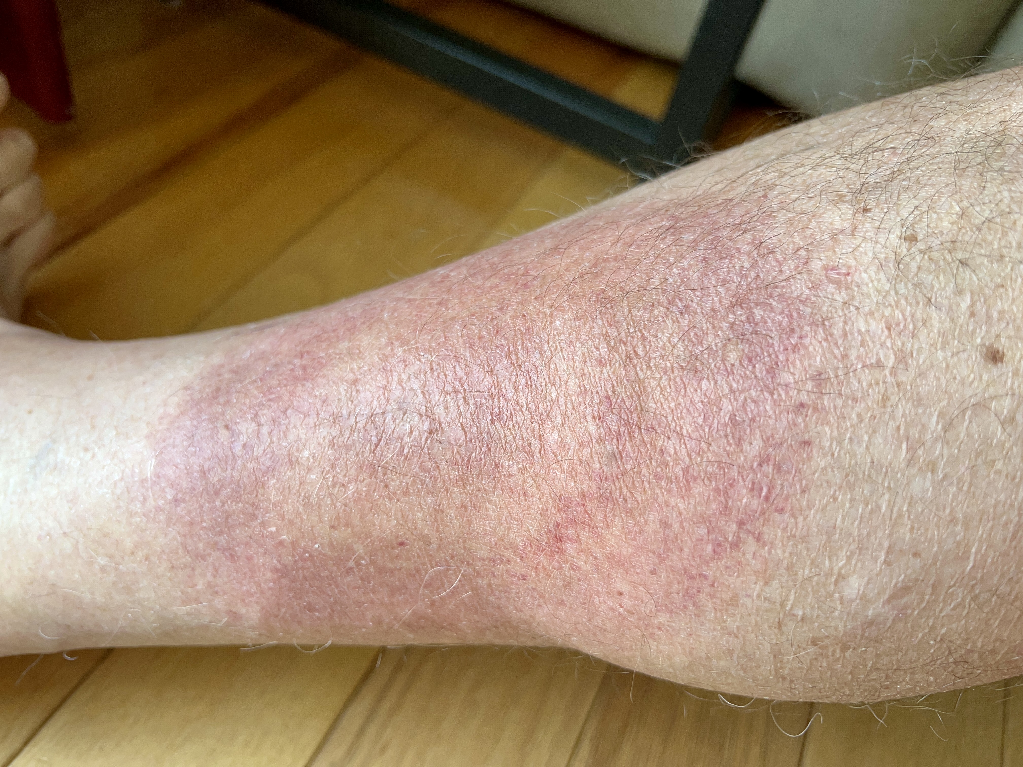 tuesday morning red rash | 4 days on doxy tuesday morning red rash | 4 days on doxy