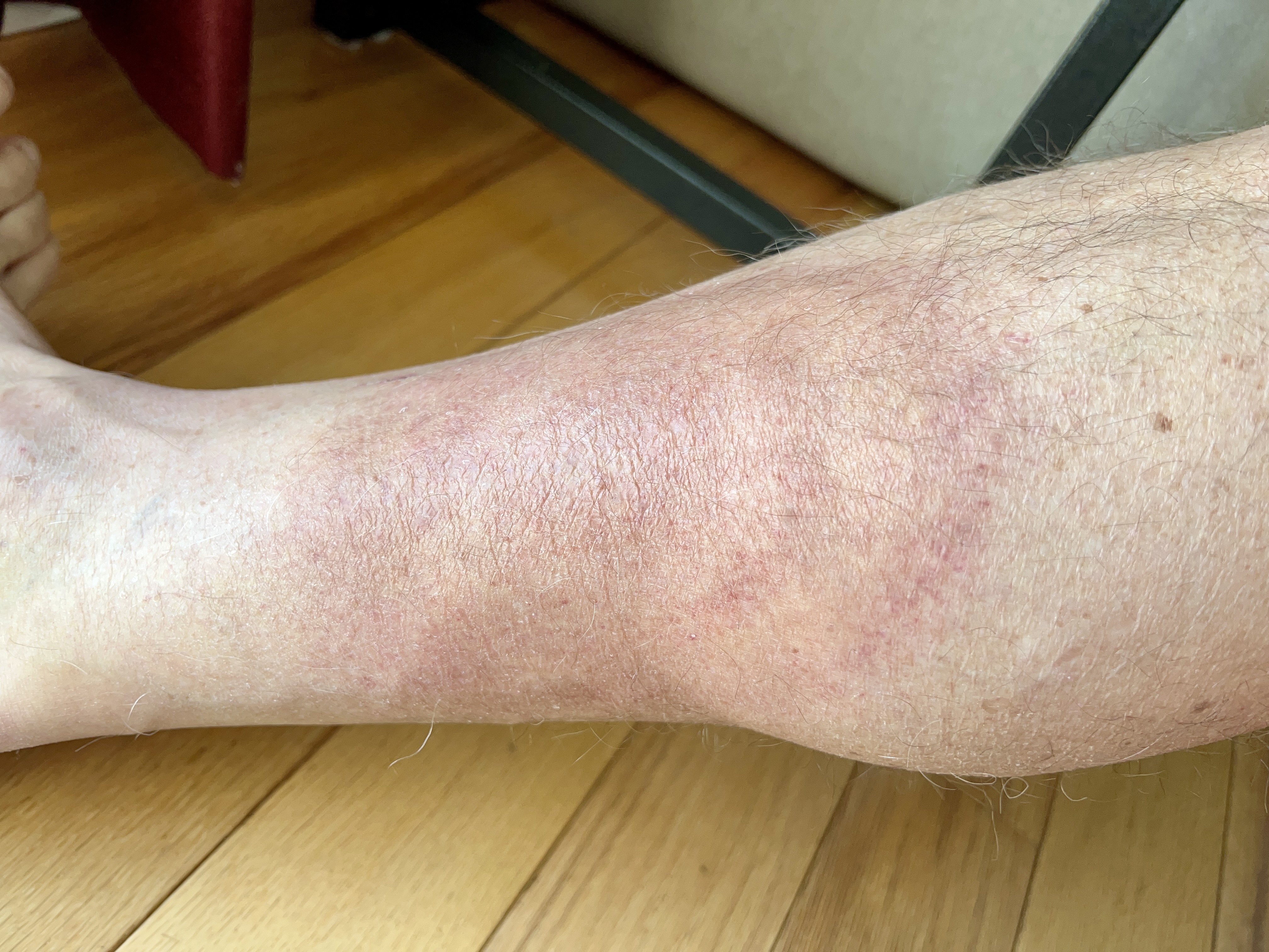 wednesday morning red rash | 5 days on doxy wednesday morning red rash | 5 days on doxy