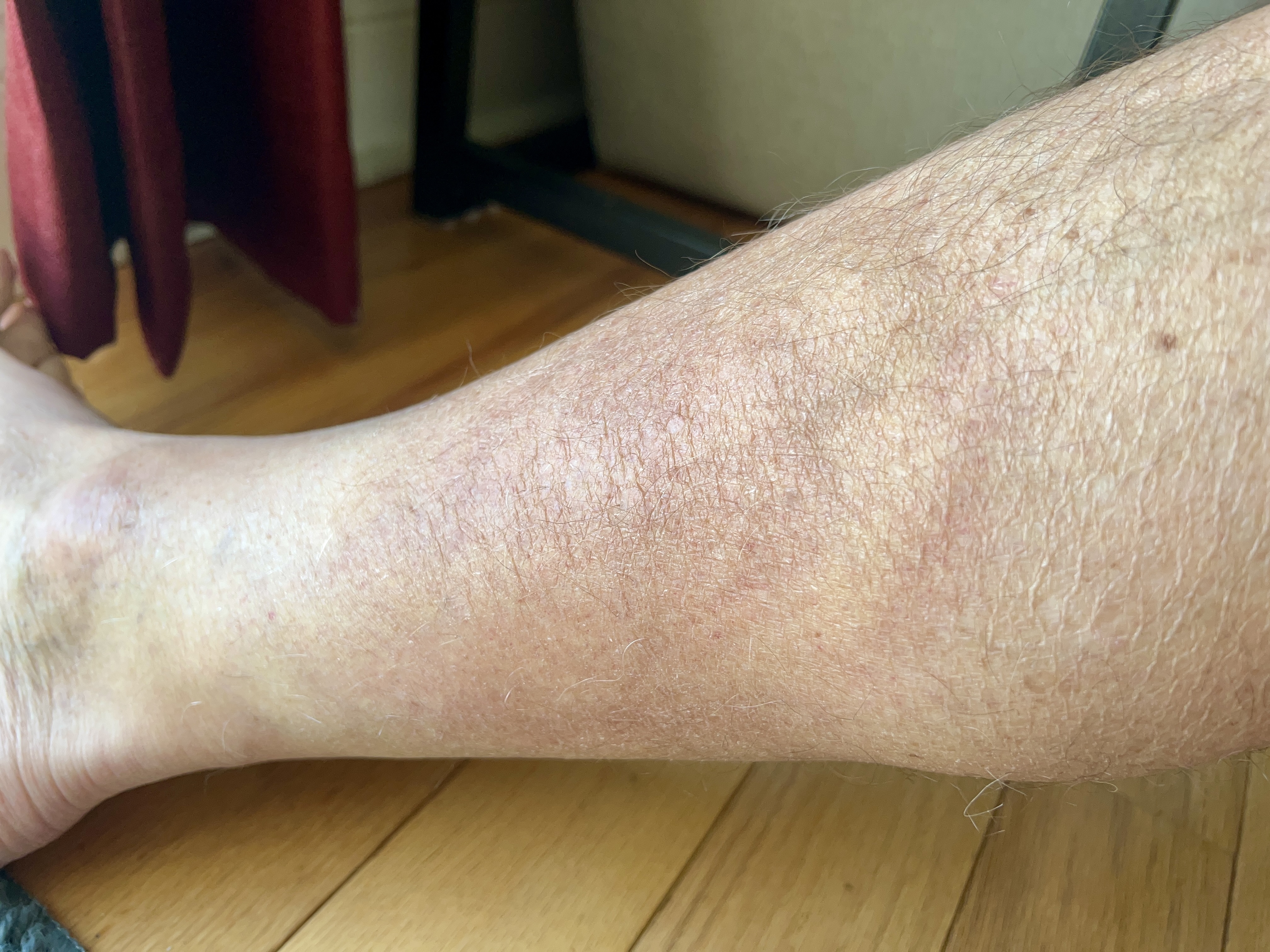 thursday morning red rash | almost gone thursday morning red rash | almost gone