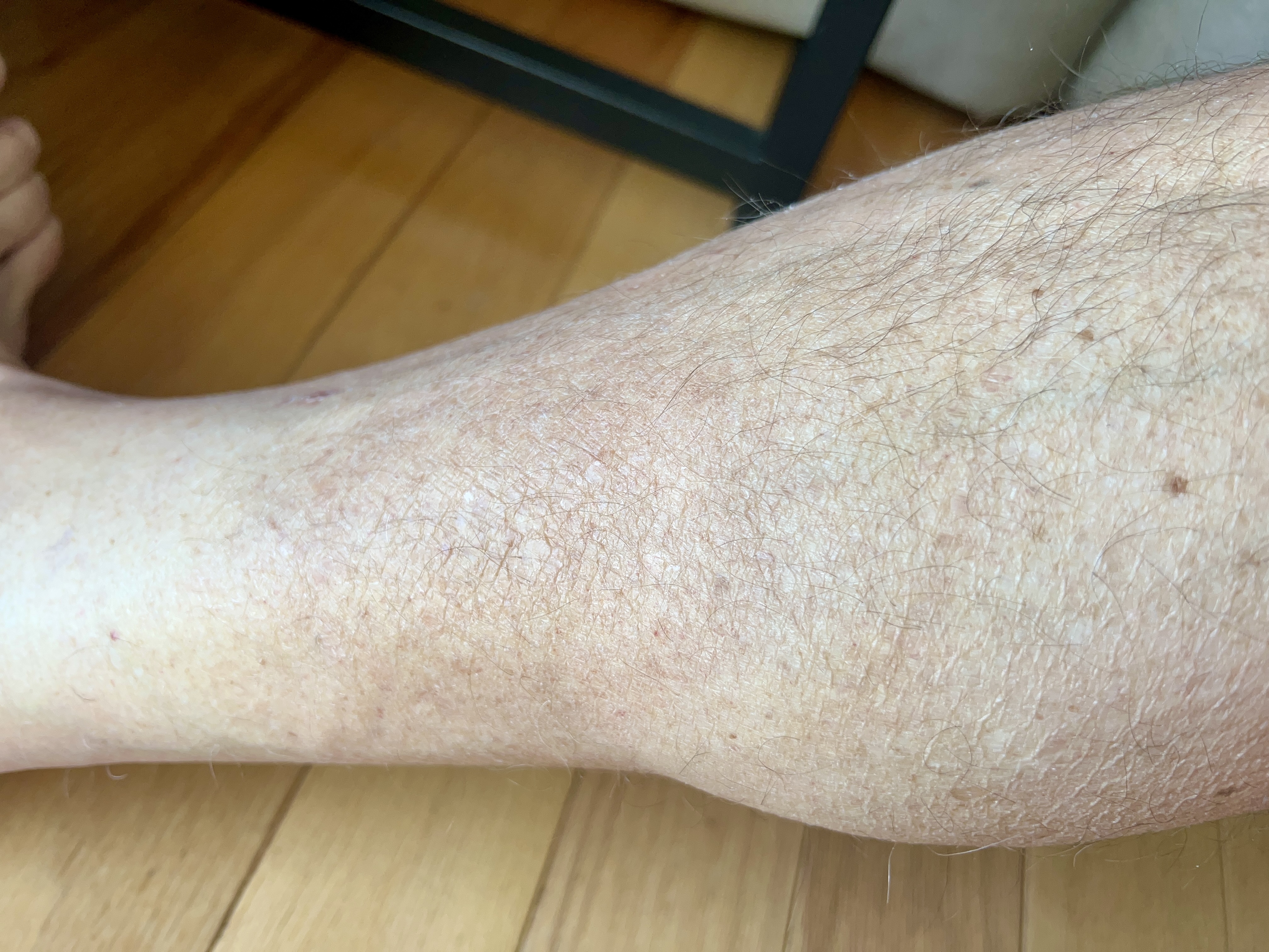 friday morning red rash | barely noticeable friday morning red rash | barely noticeable